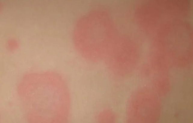 楊浩康(Yeung Ho Hong)醫生講解甚麼是多型性紅斑 ?