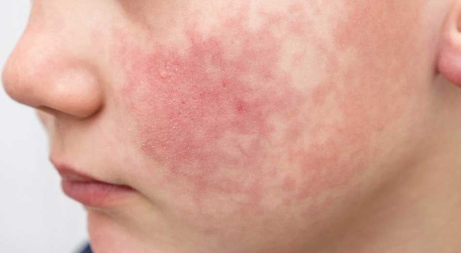 楊浩康(Yeung Ho Hong)醫生講解甚麼是第五病 / 掌摑病